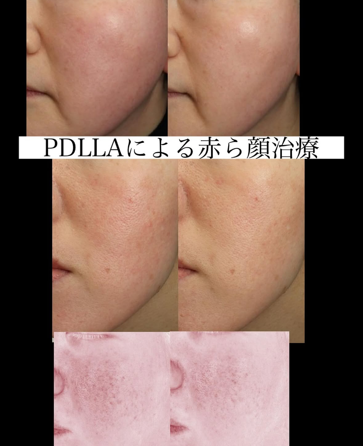 【裁断済み】皮膚血管炎 裁断済み】皮膚血管炎